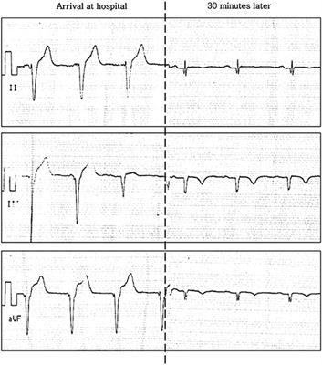 Case Report: A First Case of Spontaneous Coronary Artery Dissection Potentially Associated With <mark class="highlighted">Scuba Diving</mark>